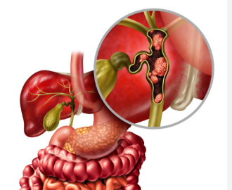 Is Duct Cancer Dangerous? What You Need to Know Right Now 2 Duct cancer anatomy illustration showing tumor growth inside the bile duct and surrounding organs